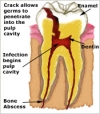 thumb__tooth_decay.jpg